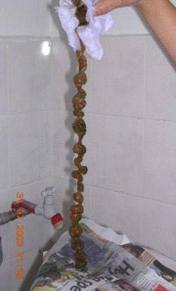 SoEasy Colon Cleanse - Long Mucoid Plaque